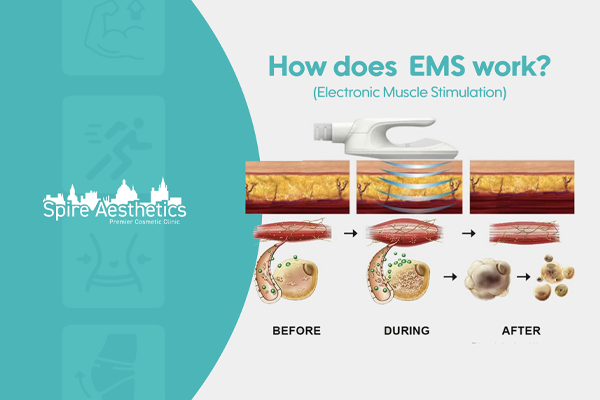 EMS treatment for post pregnancy weight loss treatment London