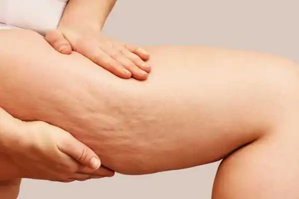Image of woman showing leg with cellulite London