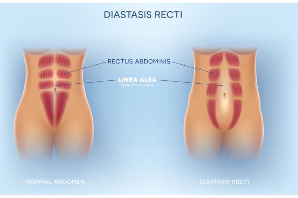 What Non-Surgical Options Are Available for Diastasis Recti London?