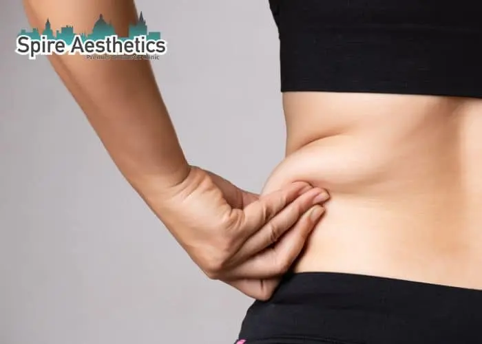 Image of woman pinching fat on their hips London. Fat Freezing treatment