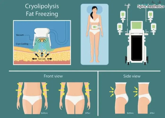 Fat freezing treatment London benefits for competitions to remove stubborn fat deposits.