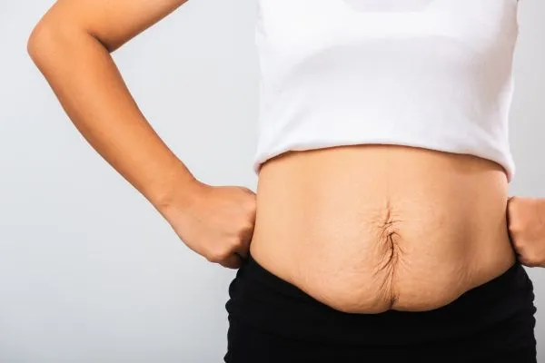 Image of a woman's stomach after weight loss with sagging skin following a gastric band London