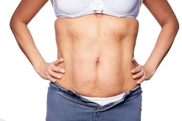 sagging skin on woman's stomach after weight loss injections London