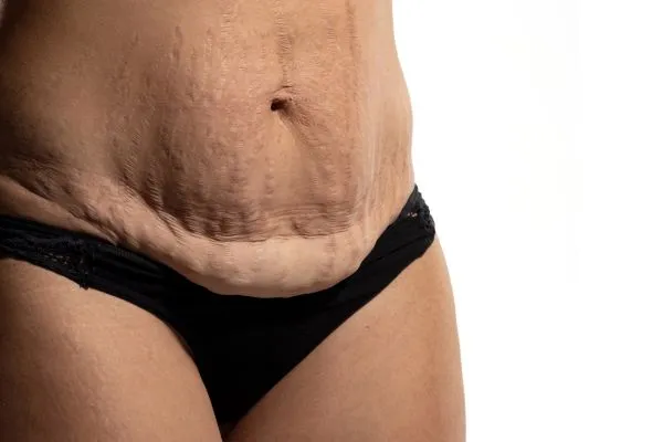 Image of womans stomach after weight loss injections London showing saggy skin