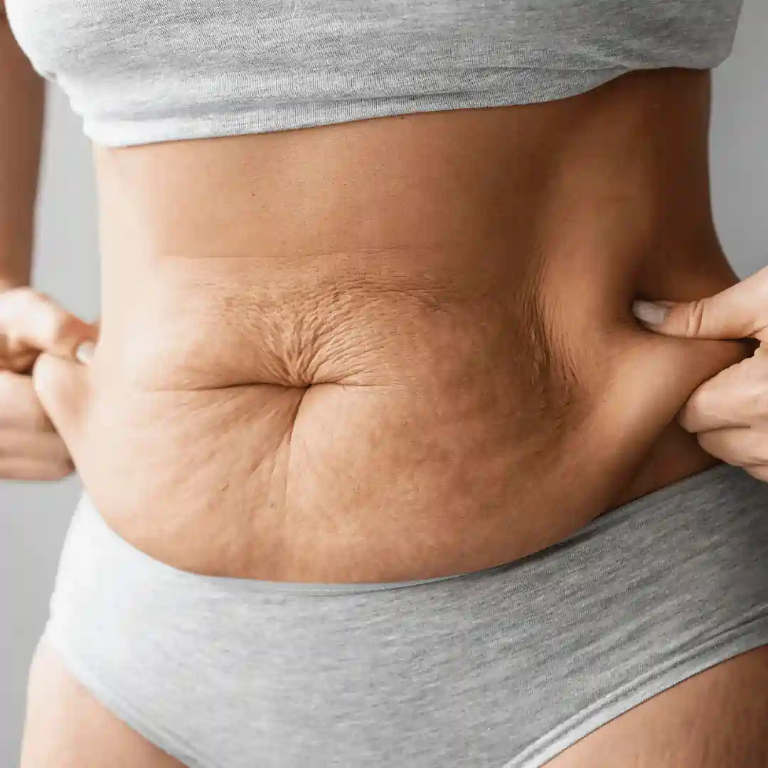 Is It Normal to Have Loose Skin After Pregnancy London?