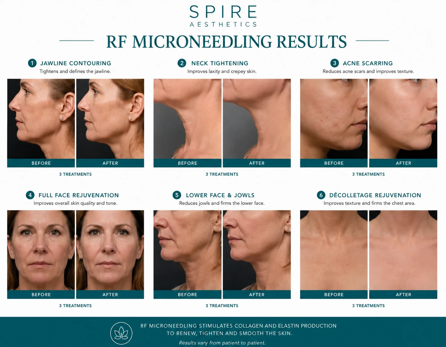 RF Microneedling Skin tightening London results
