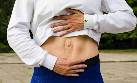 When Could Diastasis Recti Be the Missing Piece of the Puzzle London?