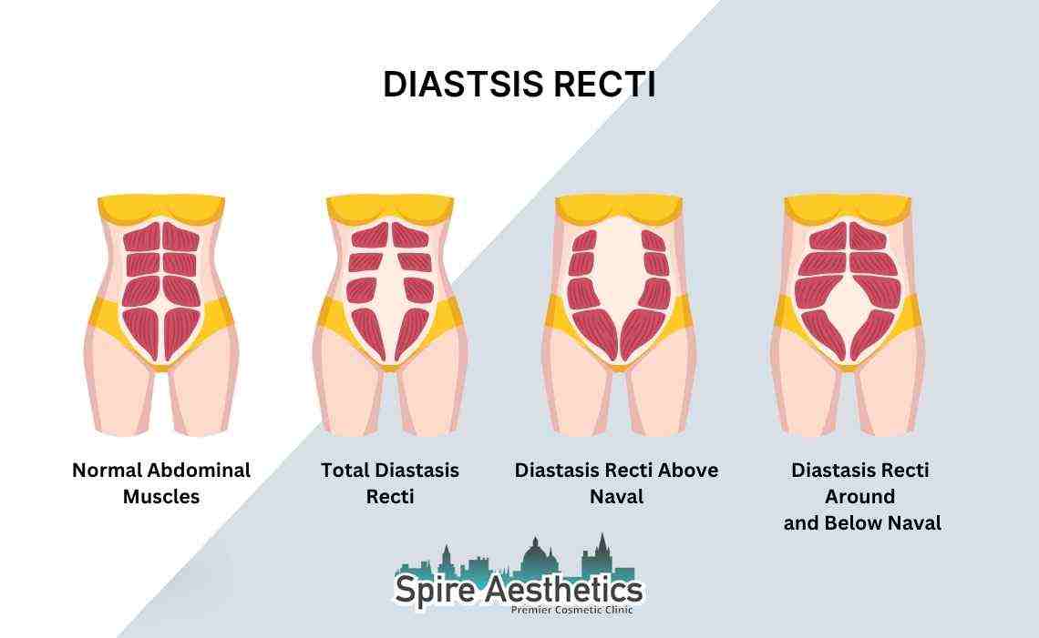 Is Non-Surgical Diastasis Recti Treatment Right for You? Common Concerns Answered London